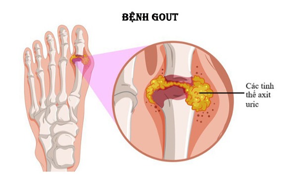 Tác hại của bệnh gout là rất nguy hiểm đến hệ cơ xương con người